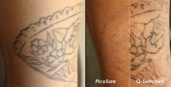 PicoSure treatment as compared to Q-Switched laser tattoo removal.