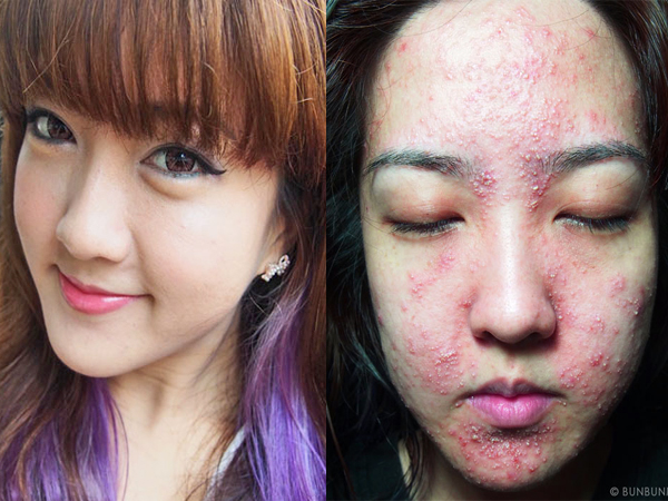 Beauty blogger, Juli, before and after her "skin-ravaging facial".