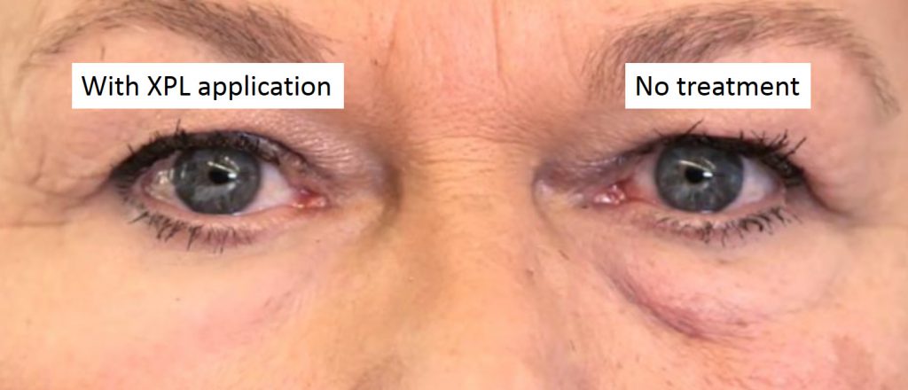 Before and after. This new second-skin technology zaps wrinkles in a flash. 