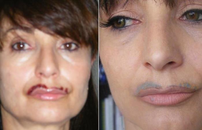 Women Left Permanently Disfigured By Beauty Salons
