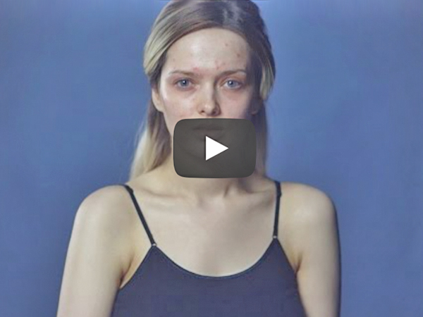 This Video On Living With Acne Will Make You Cry