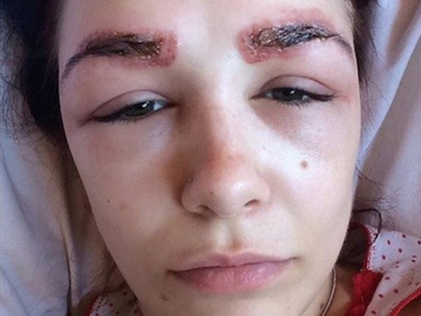 When A Brow Treatment Goes Horribly Wrong