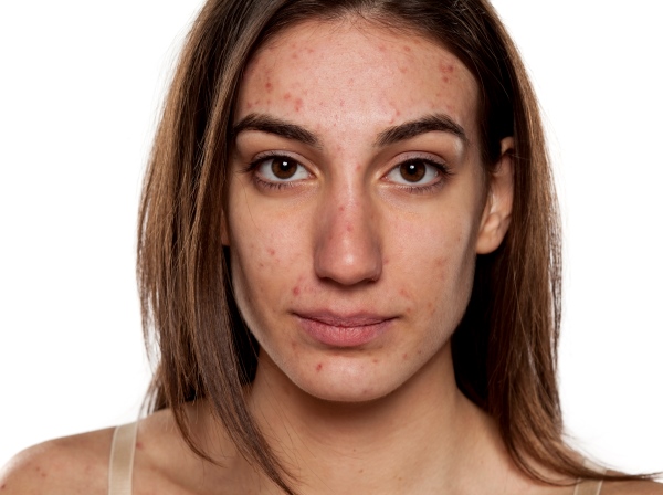 The depressing truth about acne