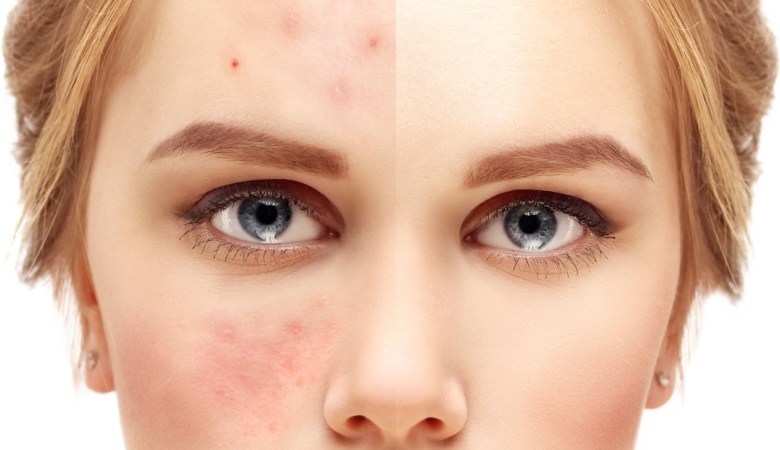UK bans acne ads