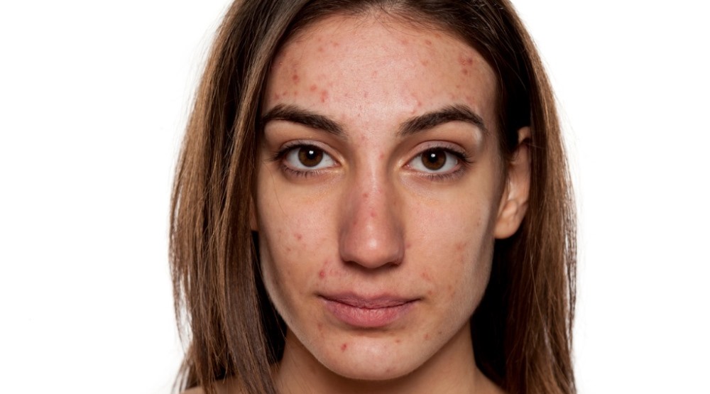 Anti-acne makeup market set to grow