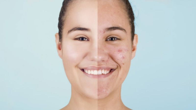 Acne – it’s only natural?