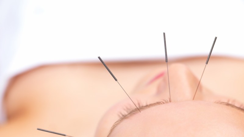 Aesthetic acupuncture: the new Botox