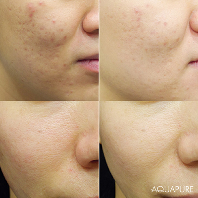 AquaPure: the all-in-one facial-care system.