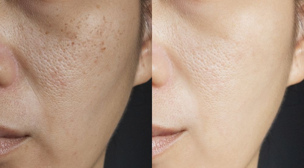 Hydroquinone can provide great results for those suffering hyperpigmentation 
