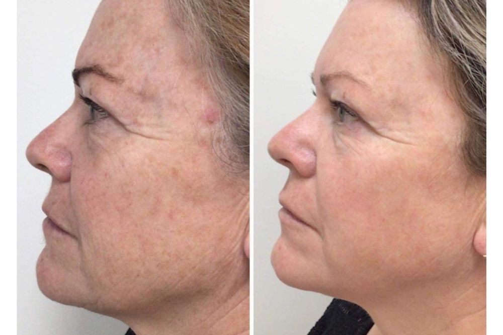 Clinic Owner Vouches for the Nordlys Device in Treating Her Patients’ Skin
