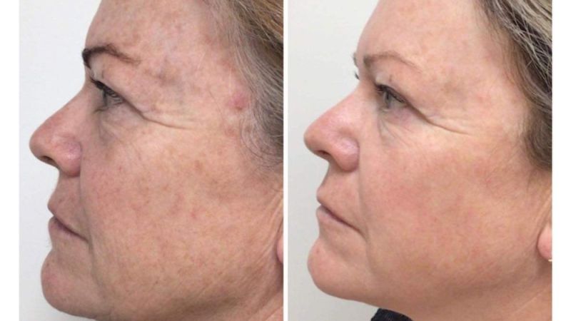Clinic Owner Vouches for the Nordlys Device in Treating Her Patients’ Skin