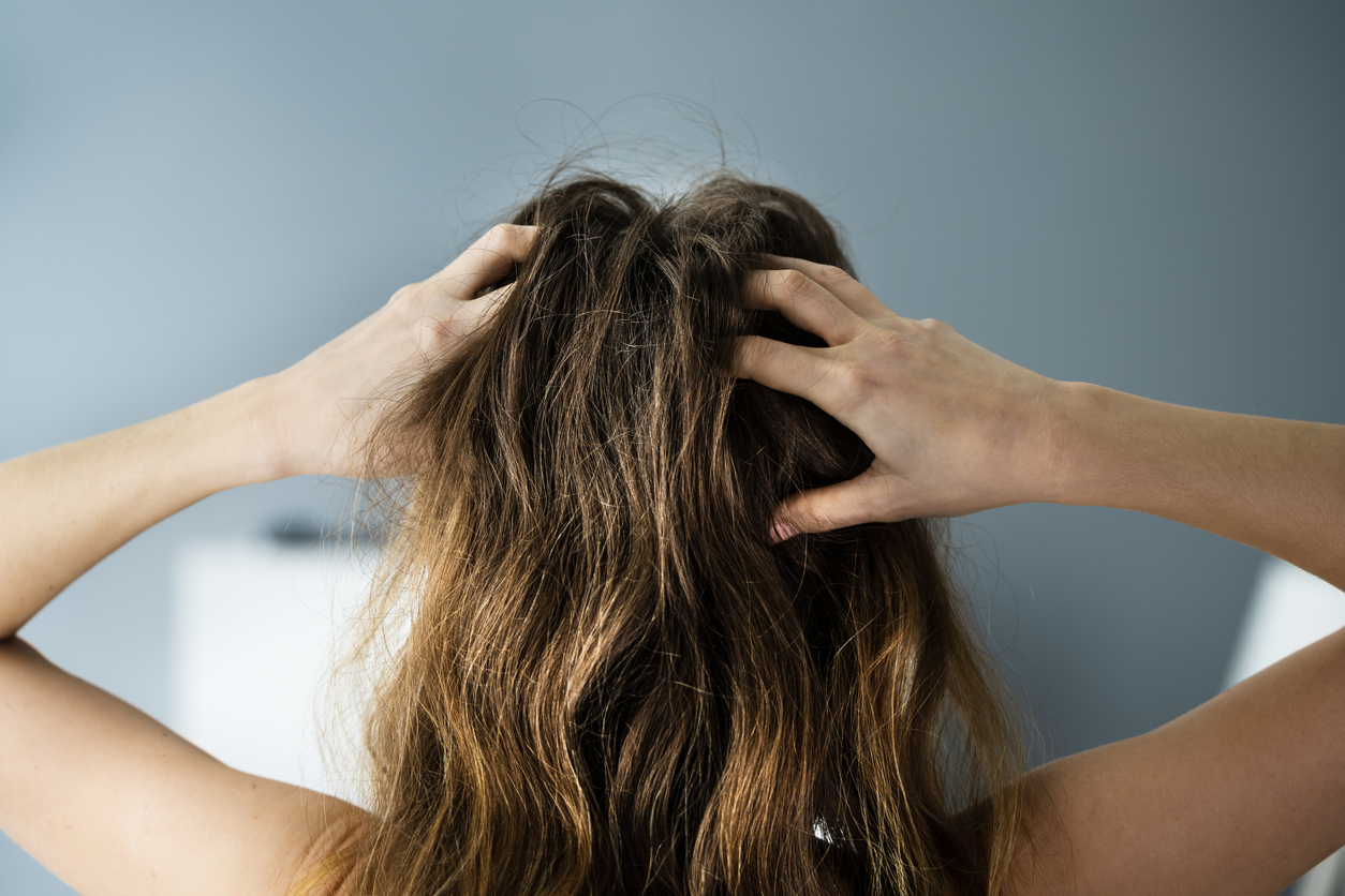 Signs of Scalp Psoriasis: How to Support Your Suffering Clients From Within Your Salon