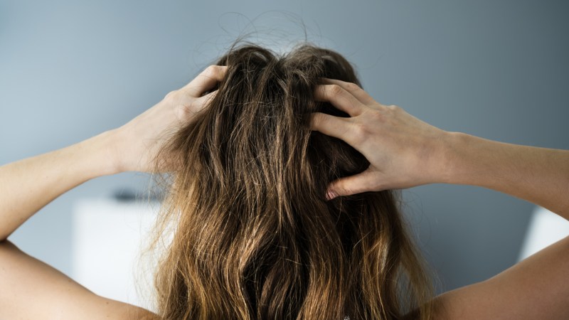 Signs of Scalp Psoriasis: How to Support Your Suffering Clients From Within Your Salon